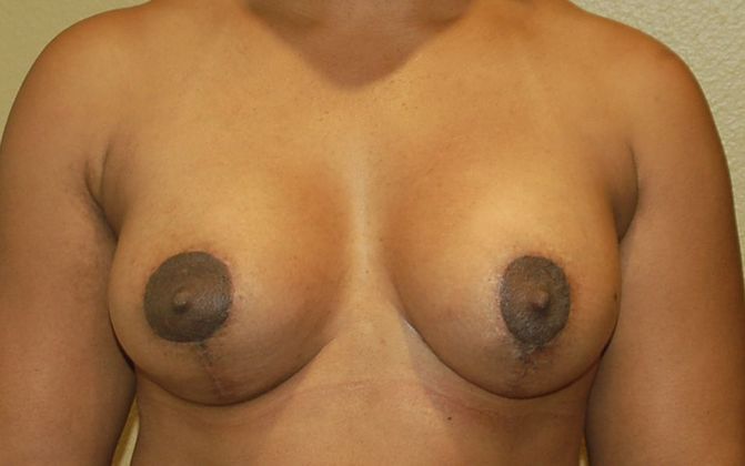 Breast Augmentation w/ Lift Case 167 - After