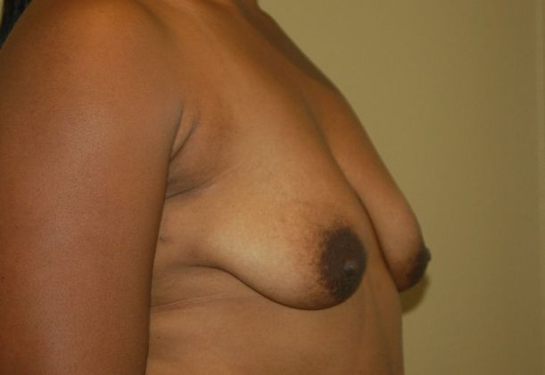 Breast Augmentation w/ Lift: Case 167 - Before
