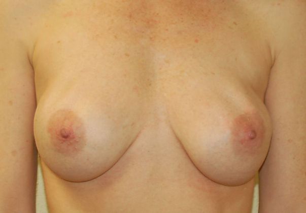 Breast Revision: Case 61 - Before