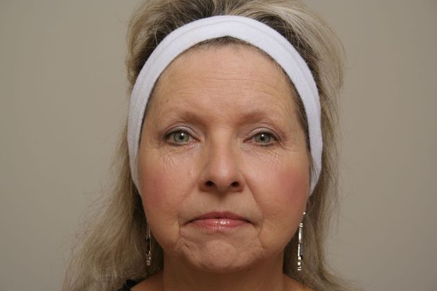 Facelift Case 10 - Before