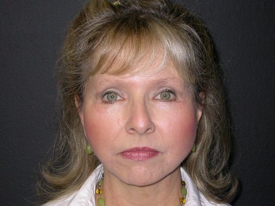 Facelift Case 10 - After