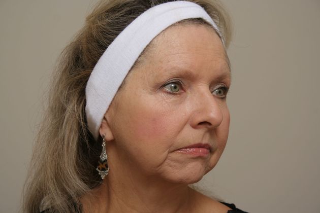 Facelift: Case 10 - Before