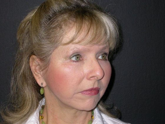 Facelift: Case 10 - After