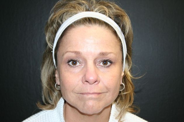 Facelift Case 11 - Before