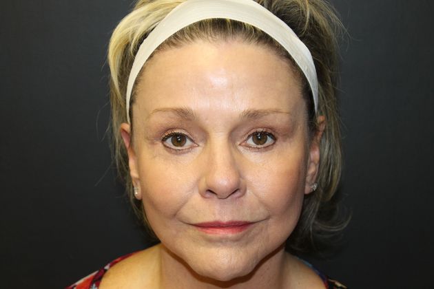 Facelift Case 11 - After