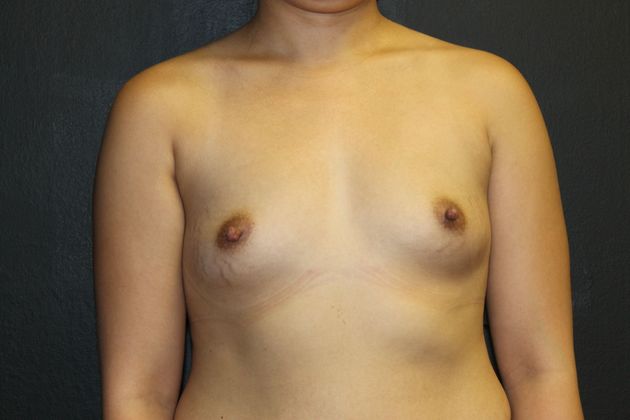 Breast Augmentation Case 11 - Before