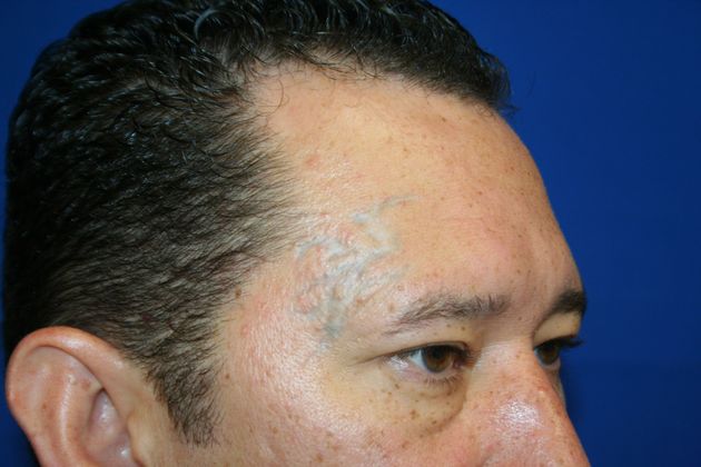 Laser Tattoo Removal  Case 1 - Before