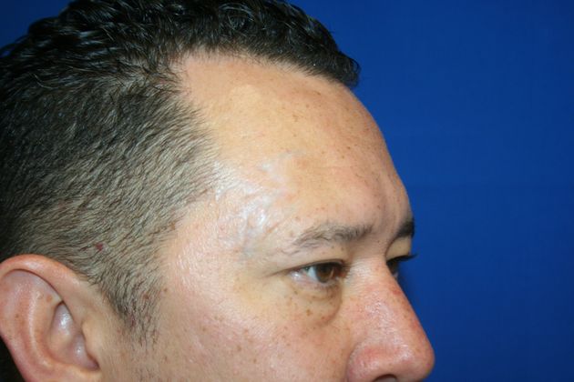 Laser Tattoo Removal  Case 1 - After