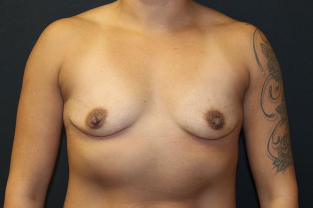 Breast Augmentation Case 13 - Before