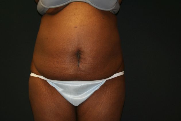 Abdominoplasty: Case 9 - Before