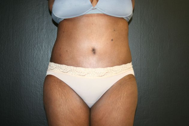 Abdominoplasty: Case 9 - After