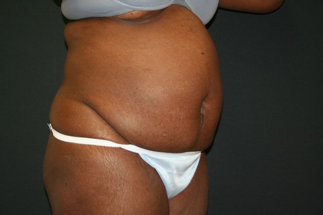 Abdominoplasty: Case 9 - Before