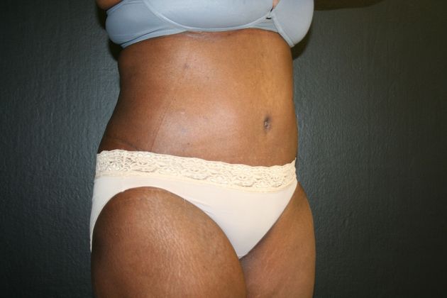 Abdominoplasty: Case 9 - After
