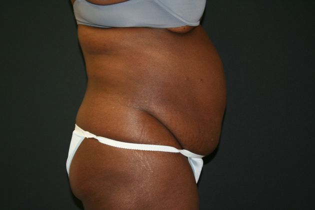 Abdominoplasty: Case 9 - Before