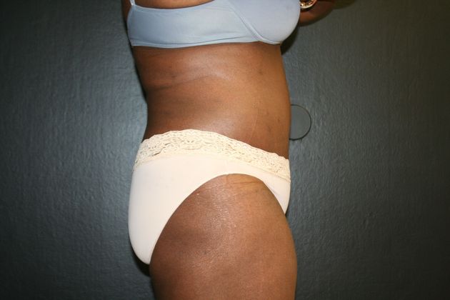 Abdominoplasty: Case 9 - After