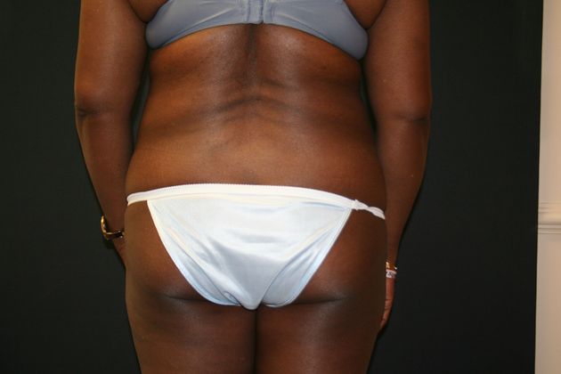 Abdominoplasty: Case 9 - Before