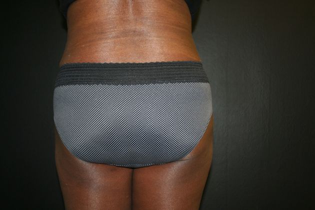 Abdominoplasty: Case 9 - After