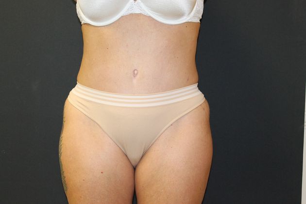 Abdominoplasty Case 10 - After