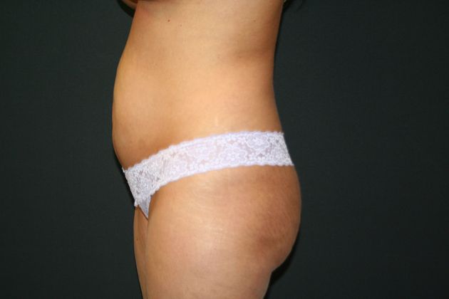 Abdominoplasty: Case 10 - Before