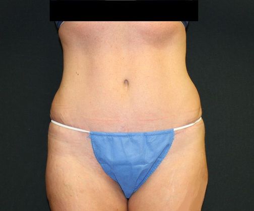 Abdominoplasty Case 25 Abdominoplasty - After
