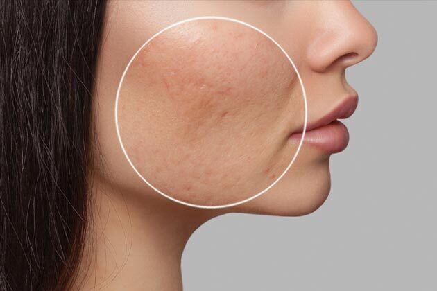 Laser Skin Resurfacing* Cases