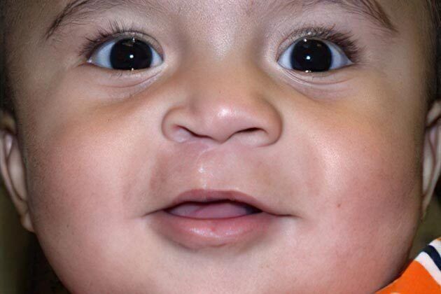 Cleft Lip* Cases