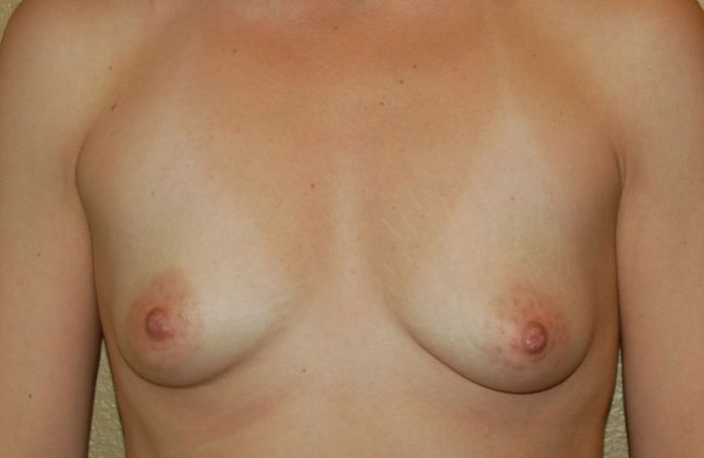 Breast Augmentation w/ Lift Case 171 - Before
