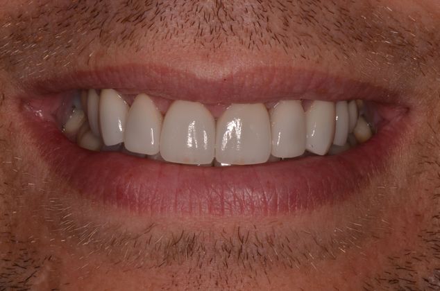 Porcelain Veneers: Case 11 - New smile with Porcelain veneers and gum lift