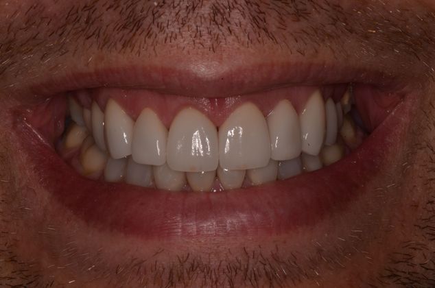 Porcelain Veneers: Case 11 - Another view of the completed smile