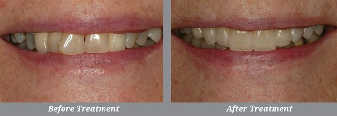 Porcelain Veneers Case