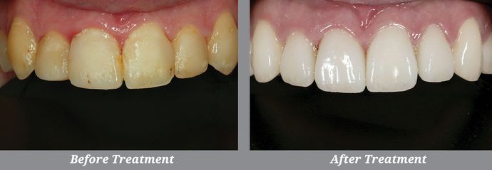 Dental Veneers Case