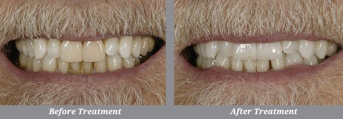 Teeth Whitening: Case 1: Oceanside, NY