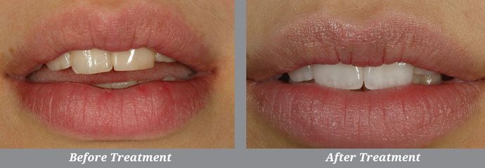 Dental Bonding Case 4: Garden City, NY