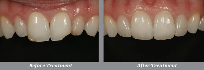 Smile Makeover Case 1: Long Beach, NY