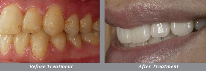 Dental Veneers: Case 1: Rockville Centre, NY