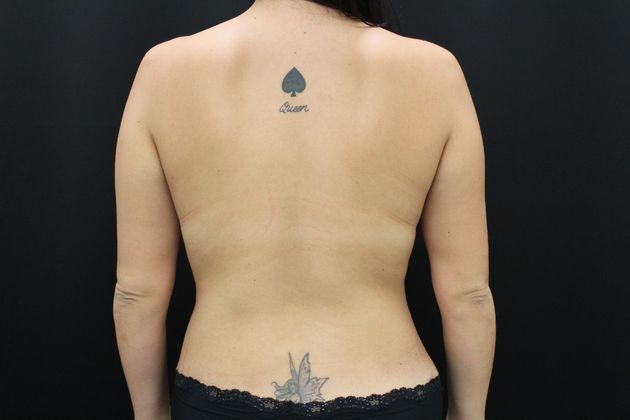 Liposuction Case 8 - After