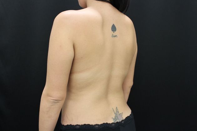 Liposuction: Case 8 - After