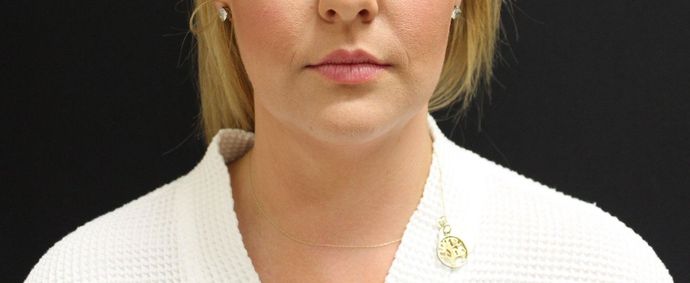 Liposuction Case 9 - Before