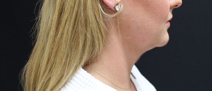 Liposuction: Case 9 - Before