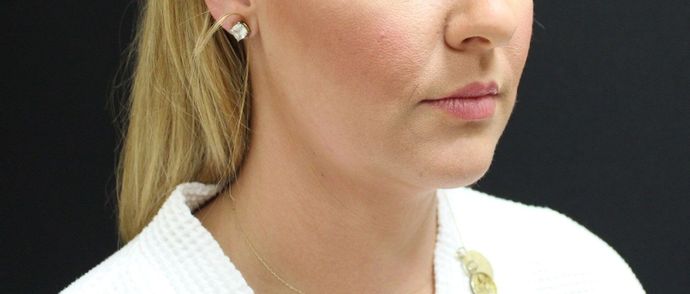 Liposuction: Case 9 - Before