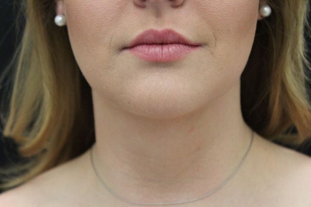 Liposuction Case 9 - After