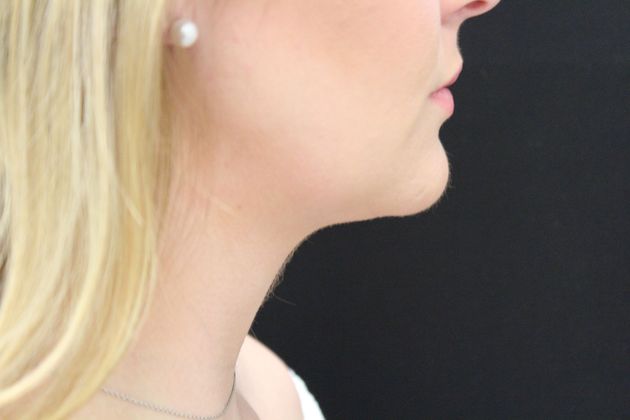 Liposuction: Case 9 - After