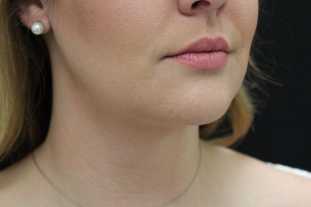 Liposuction: Case 9 - After