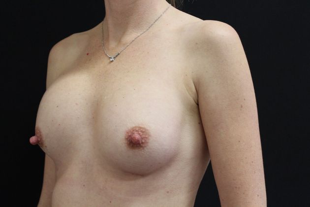 Breast Augmentation Exchange/Revision: Case 13 - before