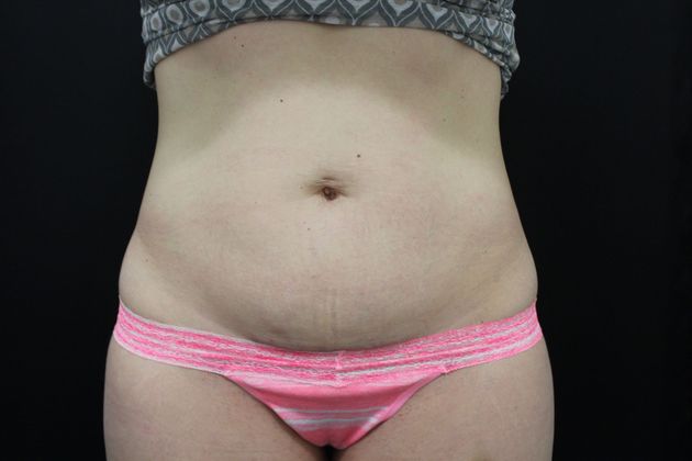 CoolSculpting Case 9 - Before