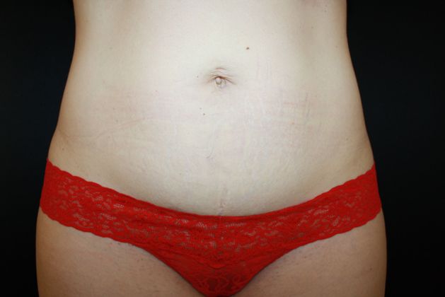CoolSculpting Case 9 - After