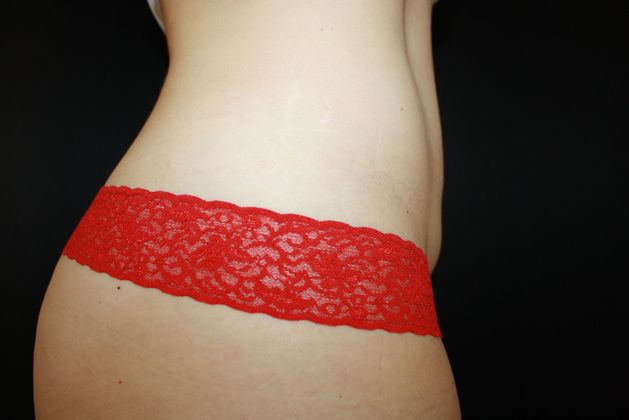 CoolSculpting: Case 9 - After