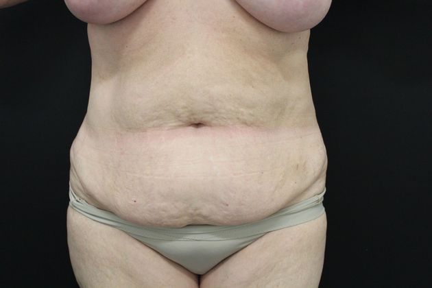 Tummy Tuck Case 21 - Before
