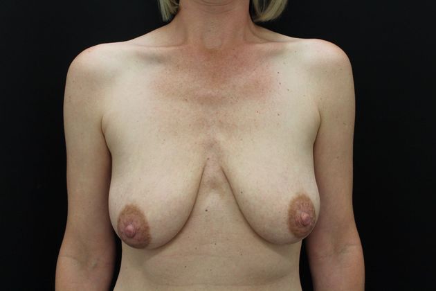 Breast Lift/Breast Lift Augmentation Case 21 - Before