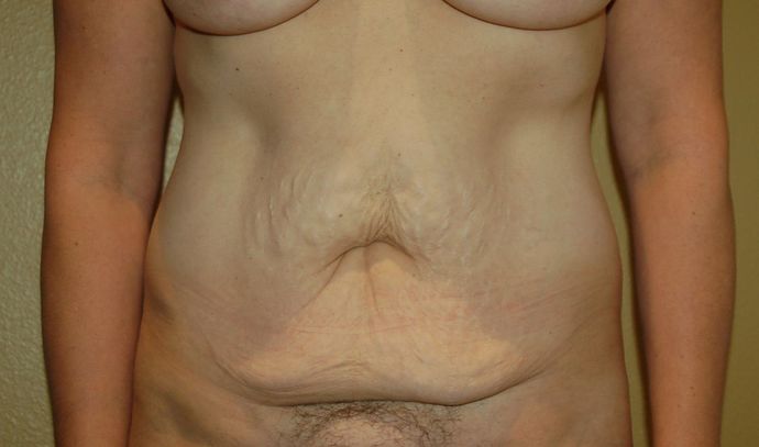 Mommy Makeover Case 73 - After